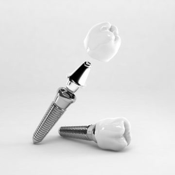 Everything You Should Know About Dental Implants