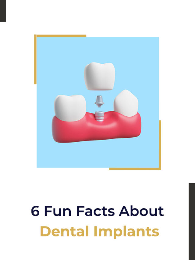 6 Fun Facts About Dental Implants