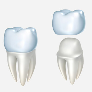 Why Does My Dental Crown Need to Be Replaced?