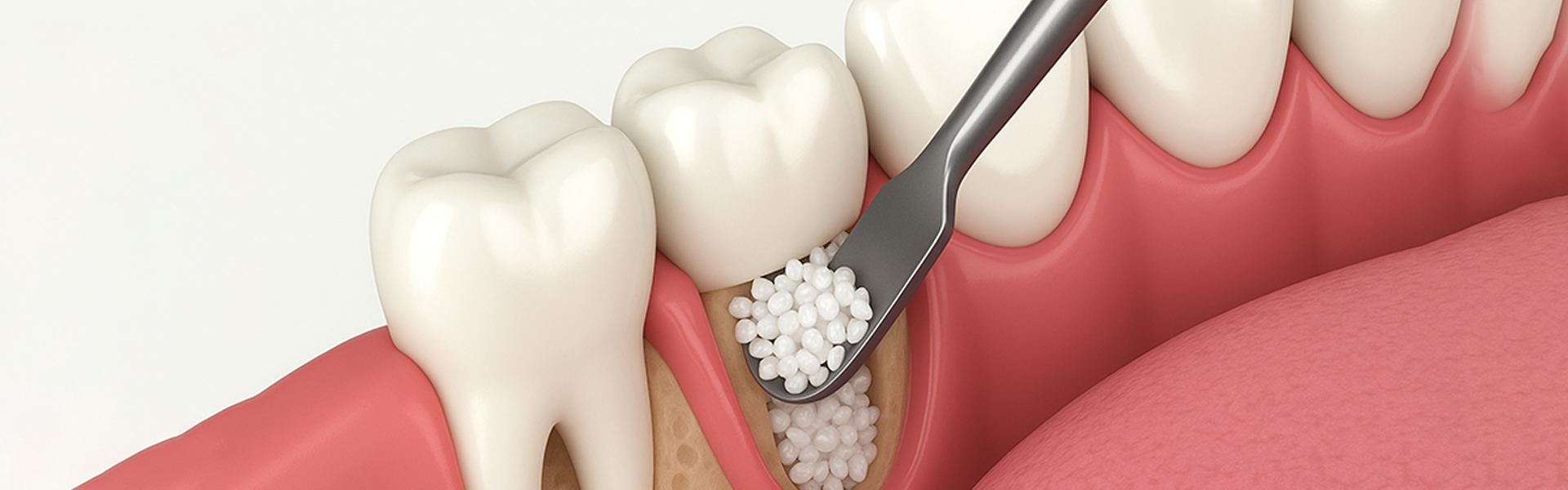 Do You Require Bone Grafting for Dental Implants? Signs & Requirements